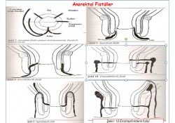 ANOREKTAL ABSE VE FİSTÜL ANOREKTAL ABSE VE FİSTÜL