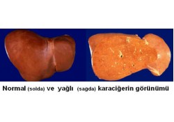 Karaciğer Yağlanması Karaciğer Yağlanması