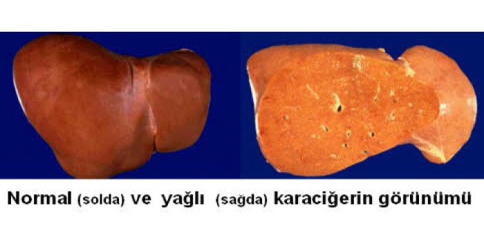 Karaciğer Yağlanması Karaciğer Yağlanması