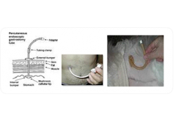 Perkütan Endoskopik Gastrostomi (PEG) Perkütan Endoskopik Gastrostomi (PEG)