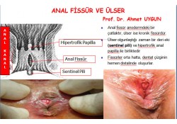 ANAL FİSSÜR VE ÜLSER ANAL FİSSÜR VE ÜLSER